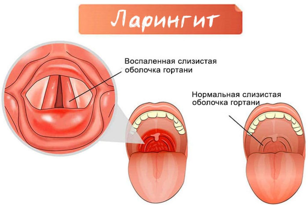 Ларингит у детей: 5 первых признаков, 6 причин, 7 симптомов, лечение в 1, 2, 3 г