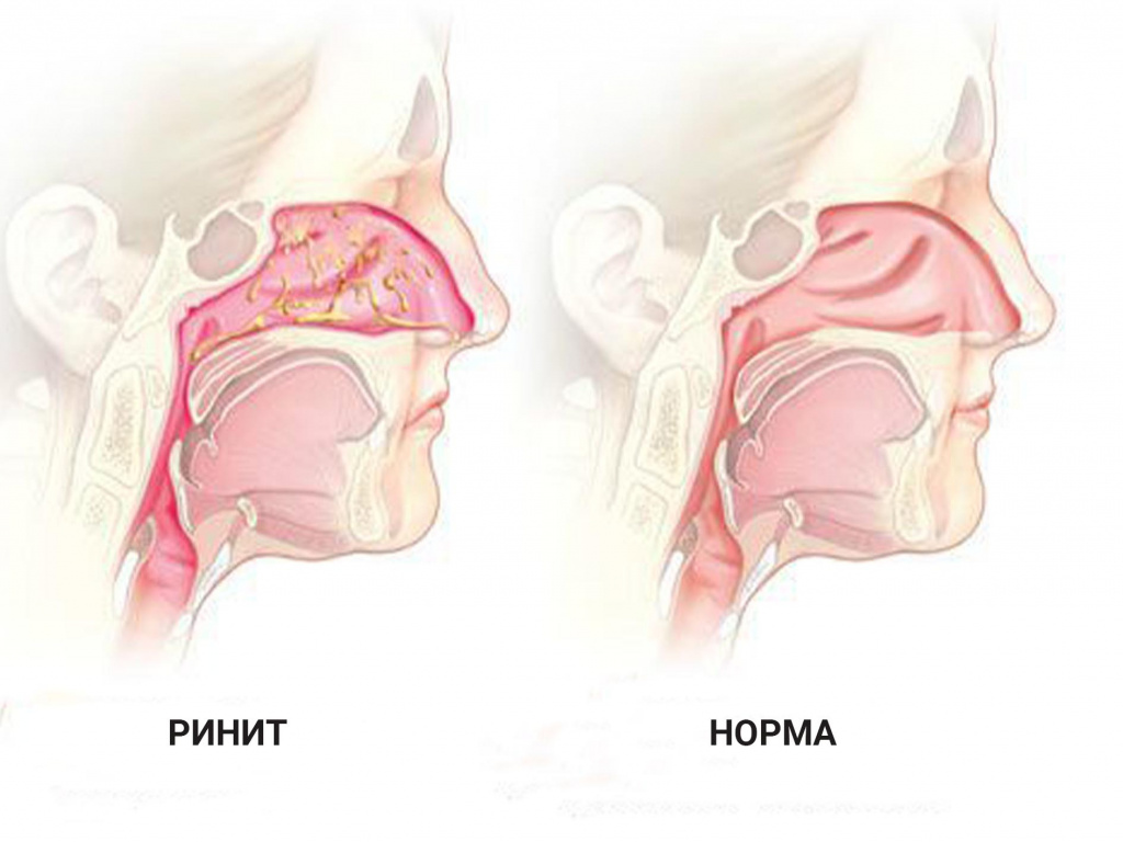 Ринит: Симптомы, Диагностика и Эффективное Лечение - Ваше Здоровье
