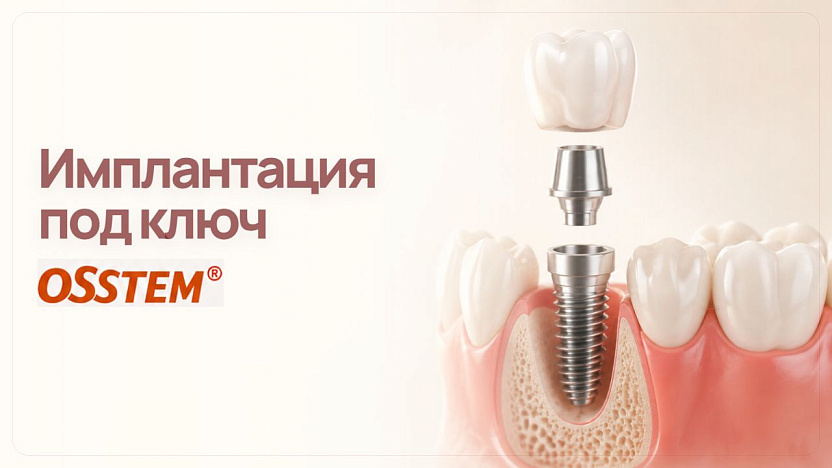 Имплантация под ключ Osstem