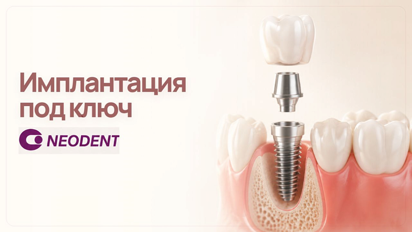 Имплантация под ключ Neodent