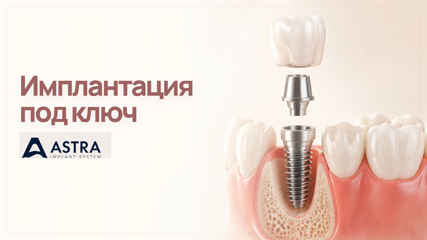 Имплантация под ключ Astra