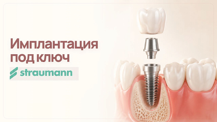 Имплантация под ключ Straumann